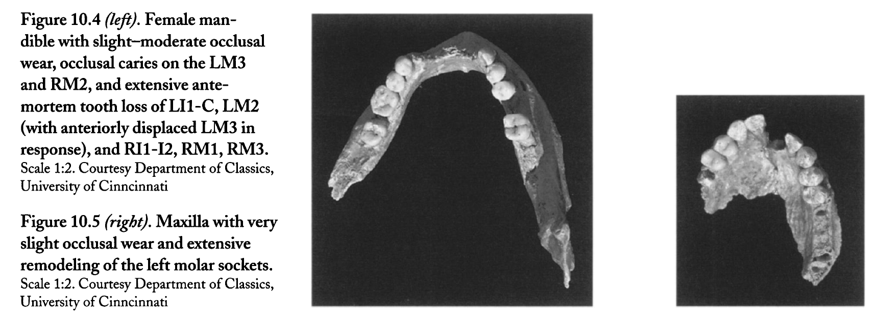Tooth loss on Mycenaean jaws
